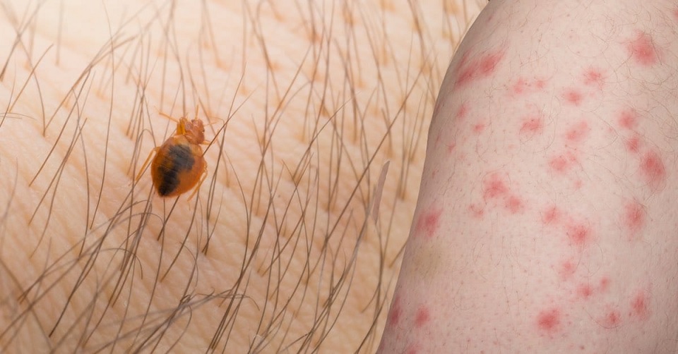 bed bug bites